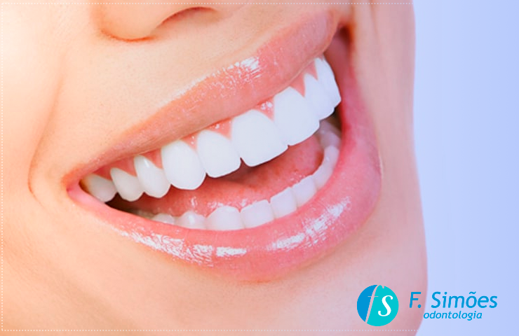 Clareamento de dentes é seguro?