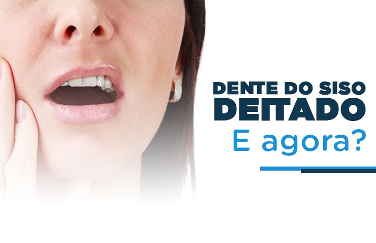 Dente do siso deitado e agora? 