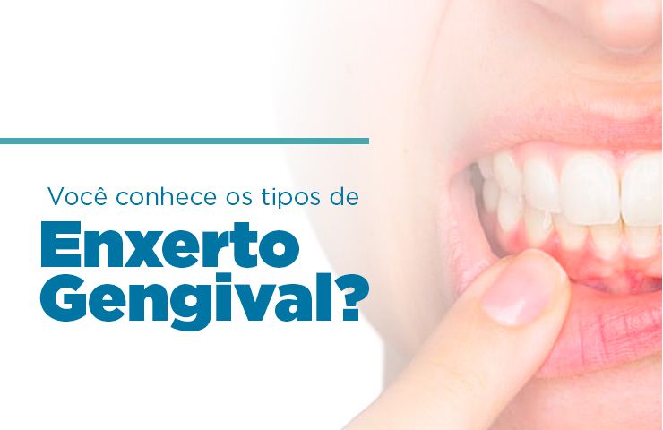 Você conhece os tipos de Enxerto Gengival?