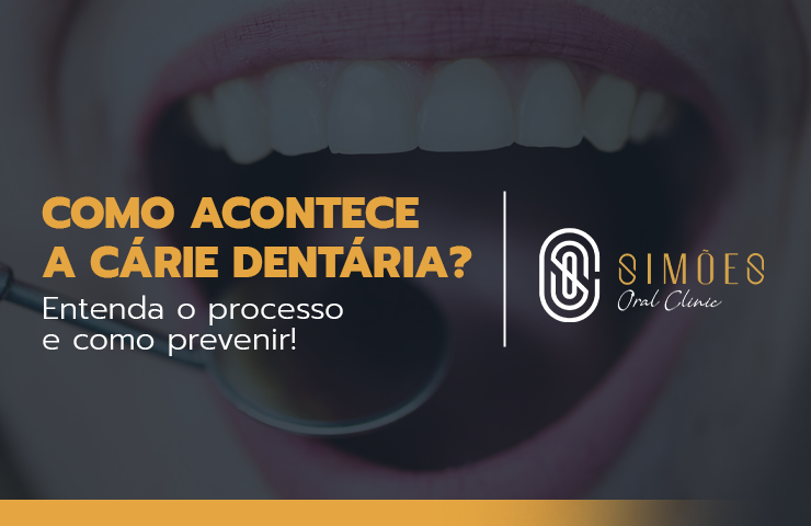 Como acontece a Cárie Dentária? Entenda o processo e como prevenir!