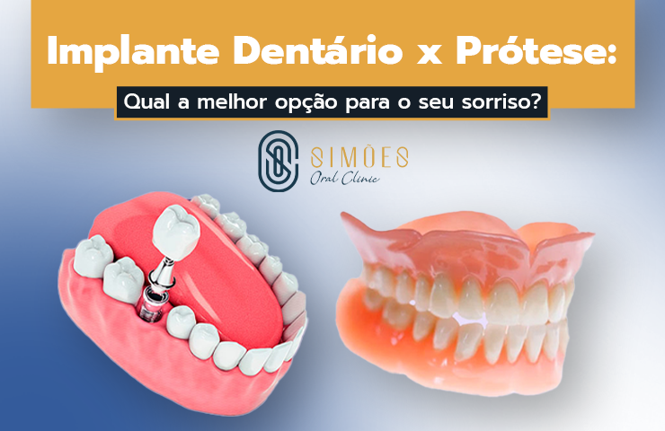 Implante Dentário x Prótese: Qual a melhor opção para o seu sorriso?