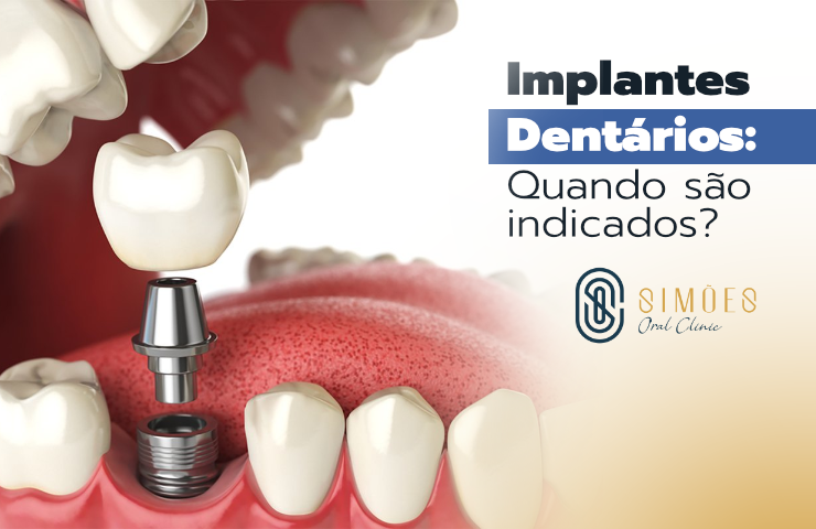 Implantes Dentários: Quando são indicados?